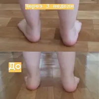 Как сделать ножки ровными немедицинскими методами