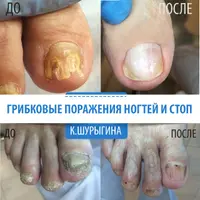 Грибковое поражение ногтей и кожи стоп