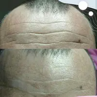 Тейпирование