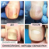 Онихолизис: методы обработки