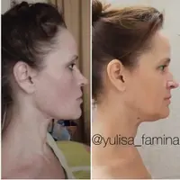 Миофейс. Коррекция позвоночника, шеи, зоны декольте