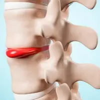 Реабилитационный фитнес при межпозвонковых грыжах