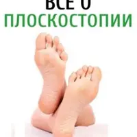 Лечение плоскостопия