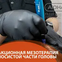Фракционная мезотерапия волосистой части головы