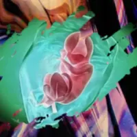 Исцеляющий кокон амниотической мембраны