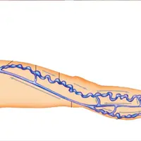 Лечение варикозного расширения вен Powerful Plus + 11x