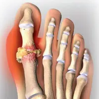 Исцеление подагры