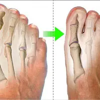 Мощное исцеление бурсита плюс 11x