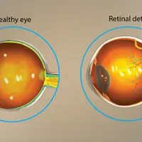 Заживление и регенерация сетчатки