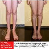 Анти-Вальгус