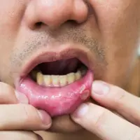 Диагностика по проявлениям в полости рта и на губах