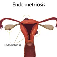 Проект «Эндометриоз»
