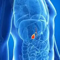 Камни в желчном пузыре