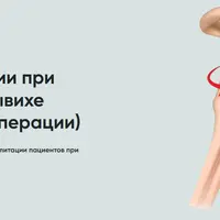 Протокол реабилитации при переднем вывихе плеча