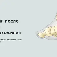Протокол реабилитации после операции на ахилловом сухожилии