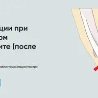Протокол реабилитации при латеральном эпикондилите