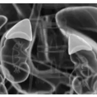 Синдром усталых надпочечников