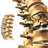 Остеопороз. Профилактика