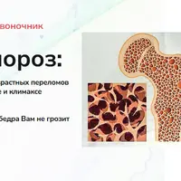 Стоп Остеопороз. Диагностика, лечение и профилактика