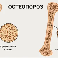 Остеопороз. Часть 1. Диагностика