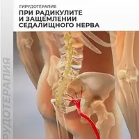 Гирудотерапия при радикулите и защемлении седалищного нерва