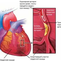 Скорая помощь после инфаркта